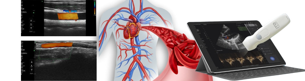 Ecografía Doppler: Precisión y Confiabilidad en Diagnósticos Vasculares